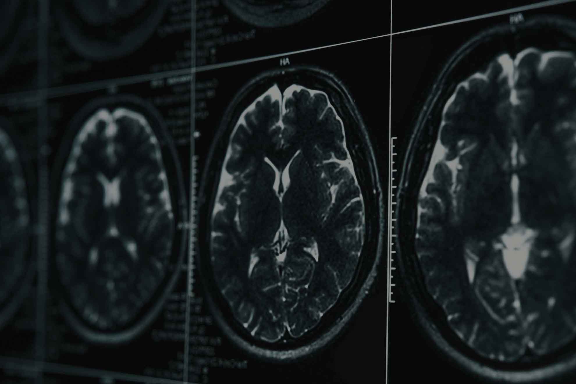Brain Injury CT Scan Results