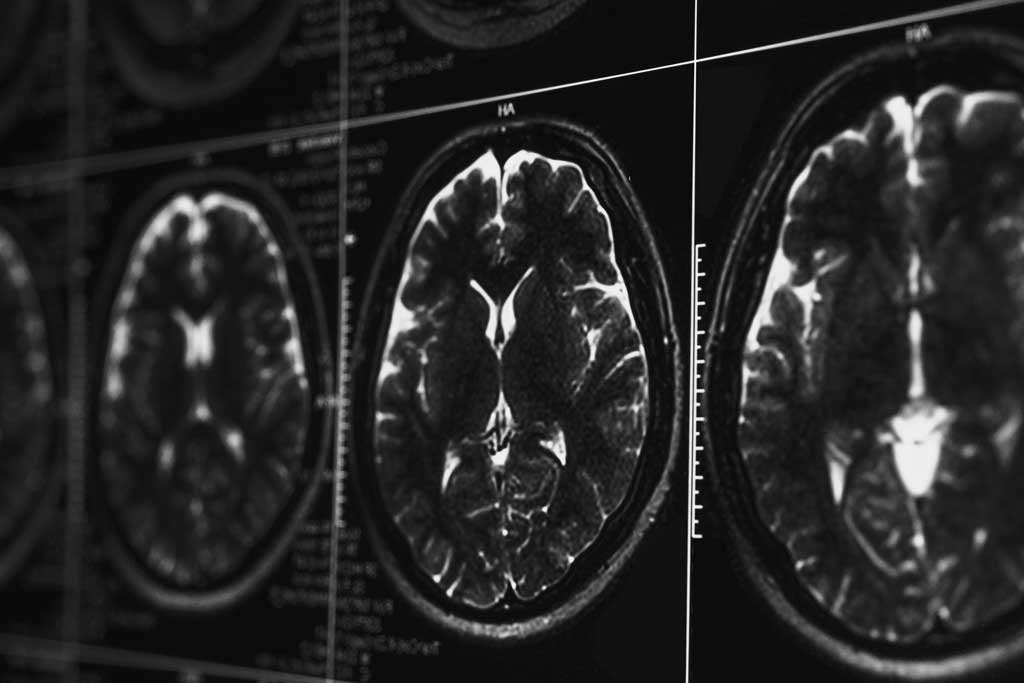 medical malpratice brain injury