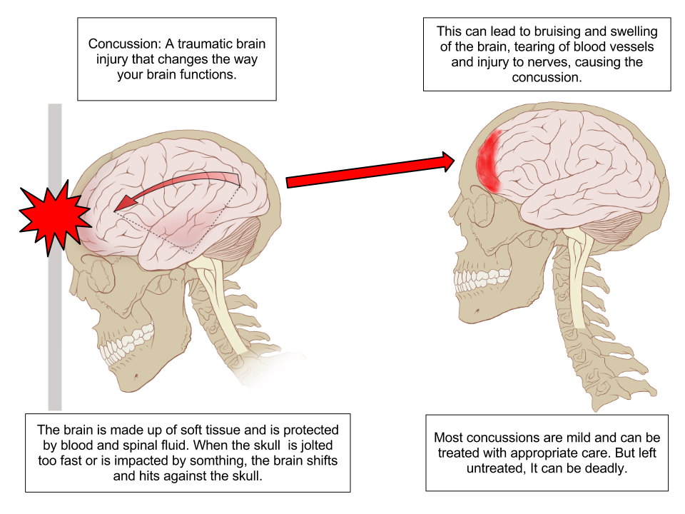 traumatic brain injury causes