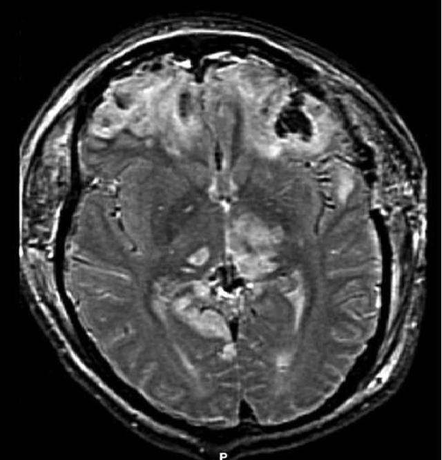 brain-injury-herniation-mri