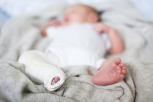 infant broken bone in cast from birth injury
