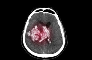 ct scan showing brain bleed