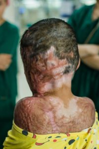 child burned on back and head